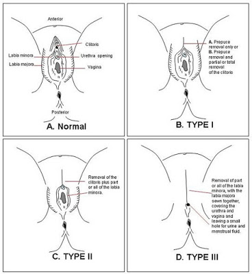 Types of female genital mutilation